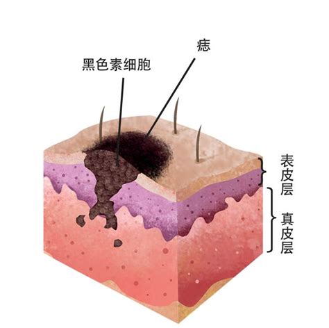 黑痣的形成